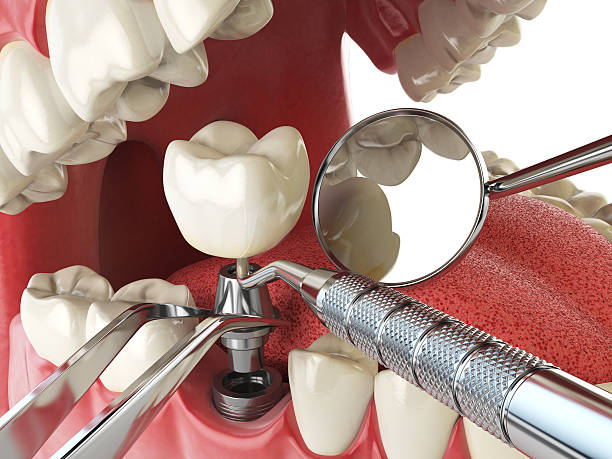 Best Emergency Wisdom Teeth Removal in Salem, UT